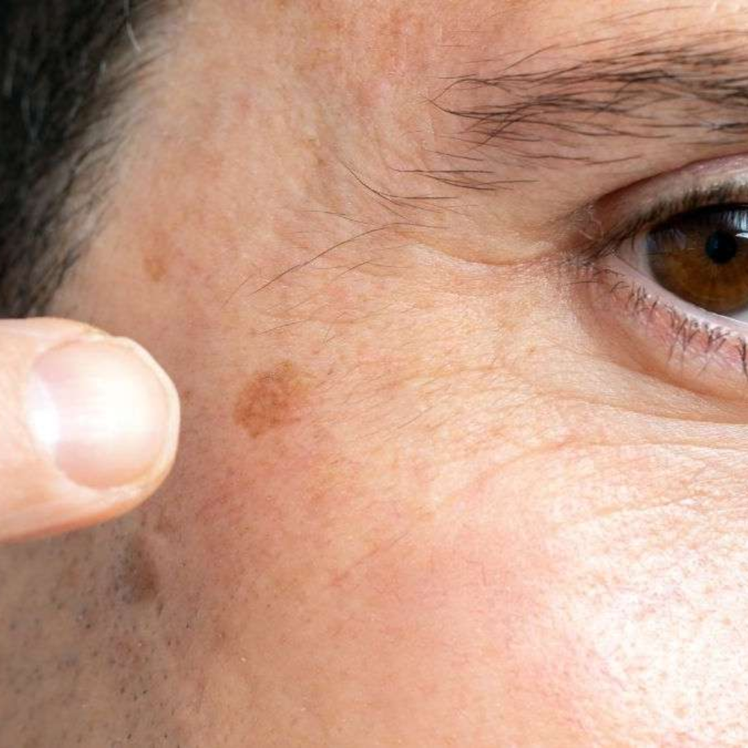 Are Age Spots Preventable?